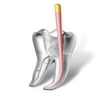 root canal treatments dominican republic