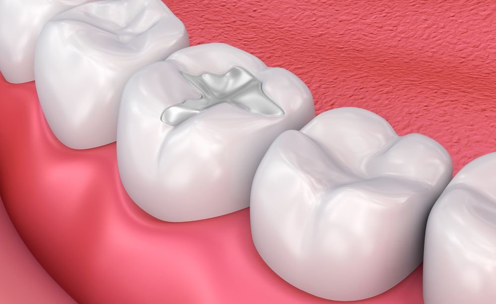 Bioceramic Dental Filling
