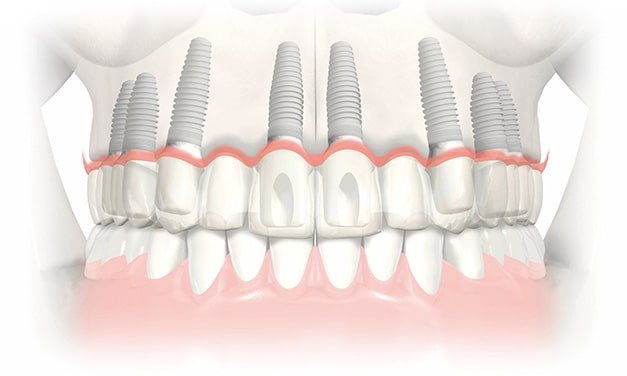 full mouth dental implants dominican republic