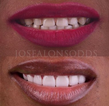Smile Makeover Dental Veneers DR Jose Alonso DDS