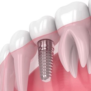 Single Dental Implant Dominican Republic