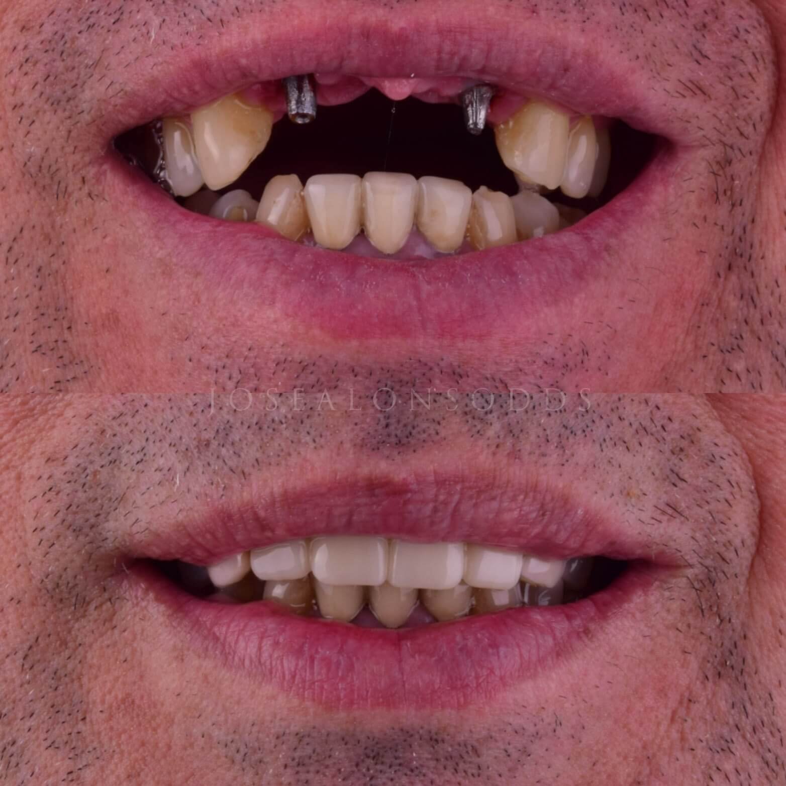 Smile Makeover Patient